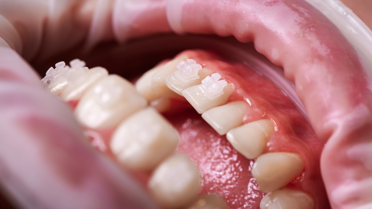 How Chewing on a Toothpick Can Harm Your Mouth