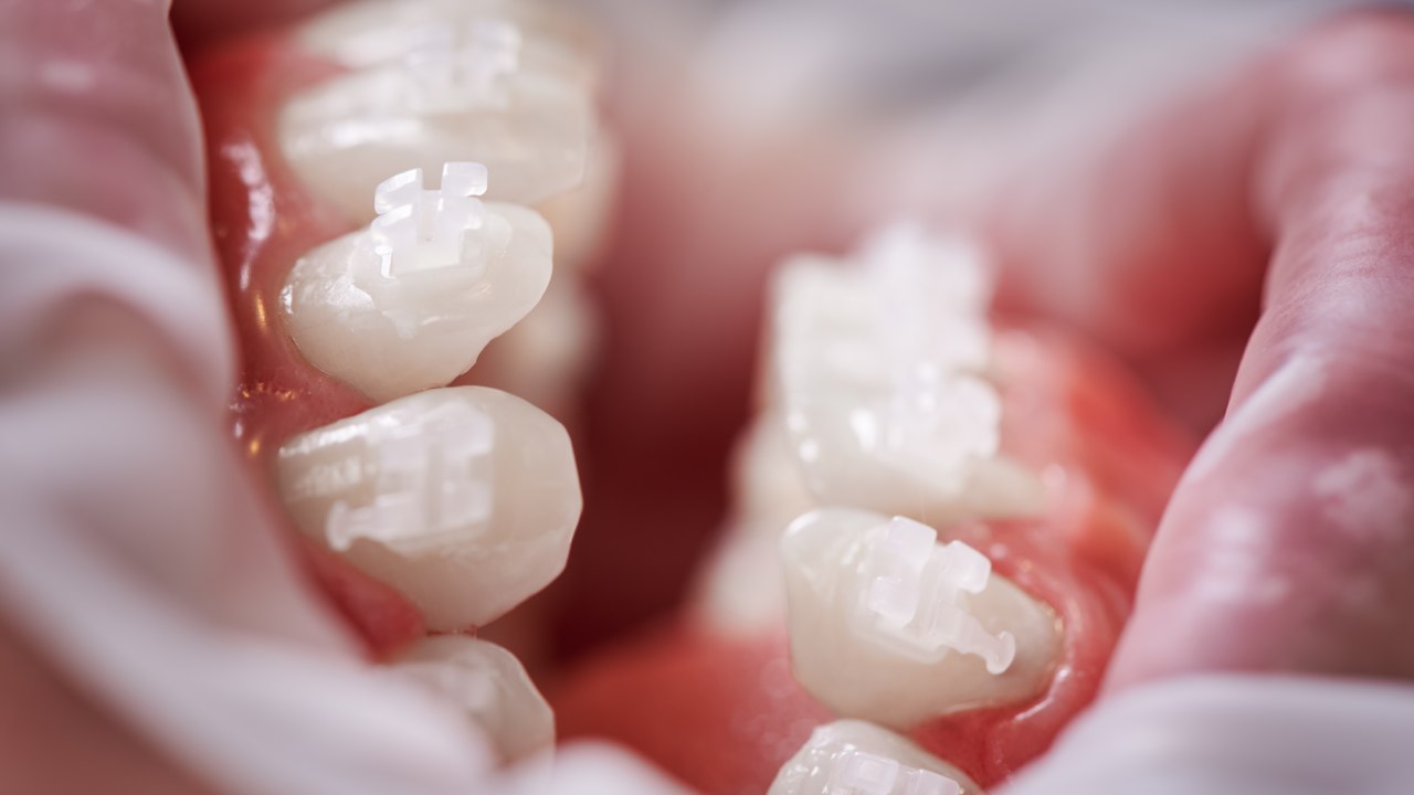 How To Keep Your Teeth Straight After Braces