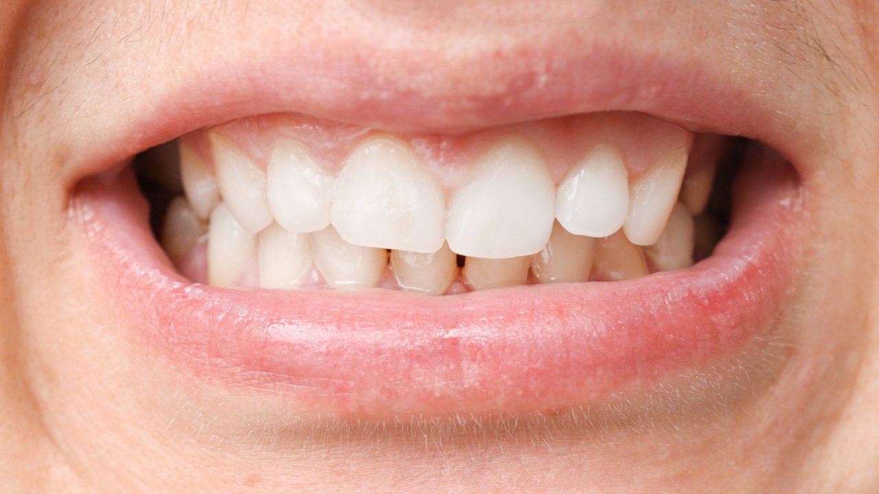 Sensitive Teeth