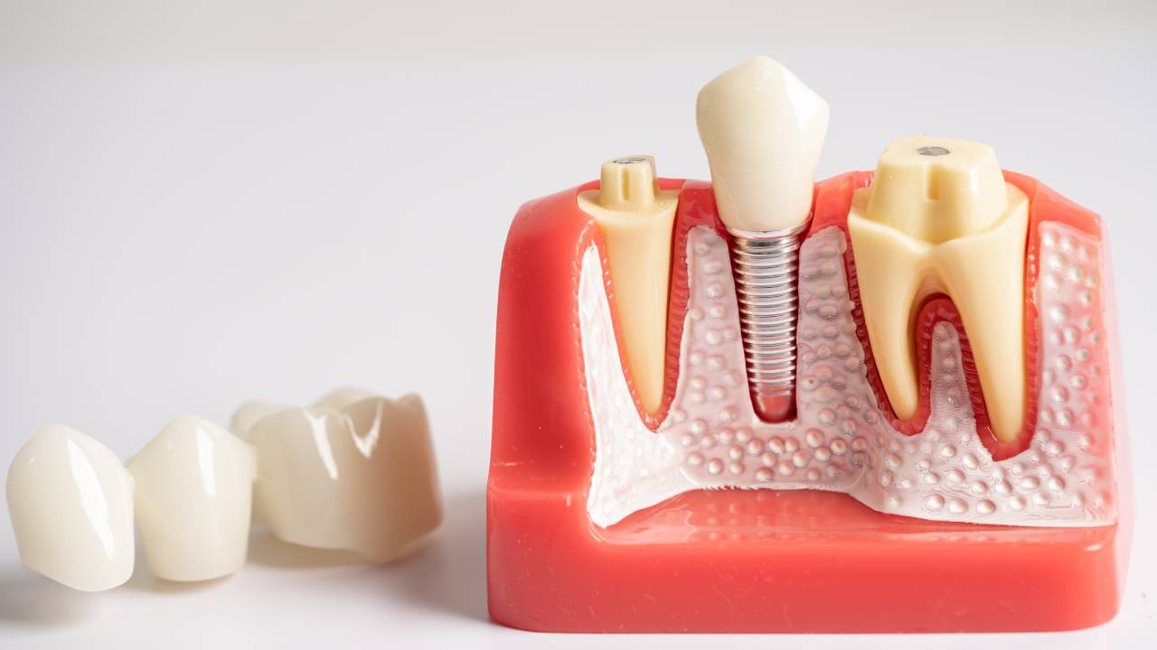 Are You a Candidate for Dental Implants?