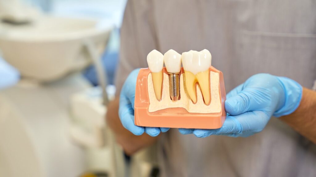 The Proper Care of Dental Implants