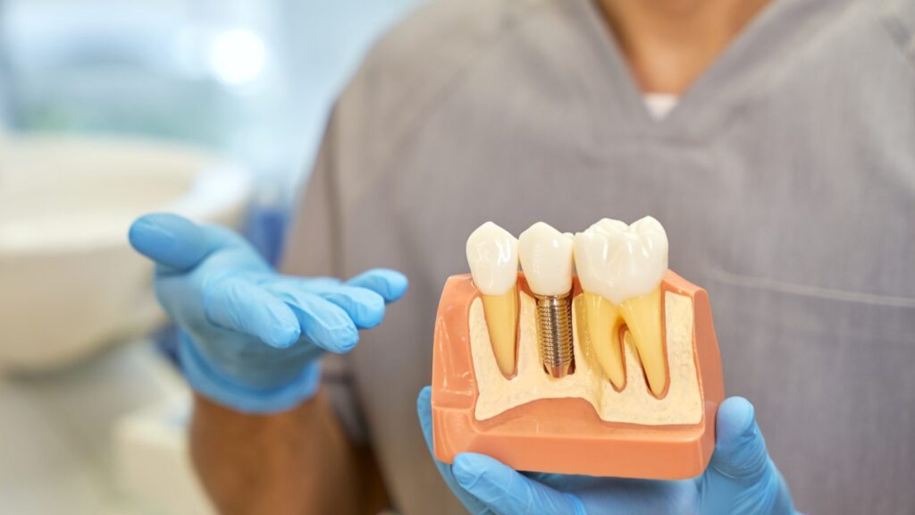 Common Dental Implant FAQs