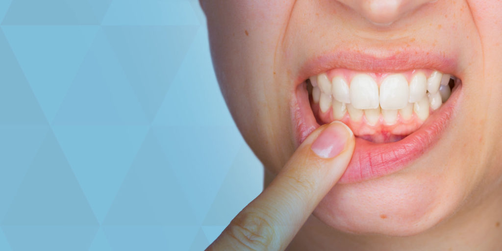 Warning Signs of Gum Disease