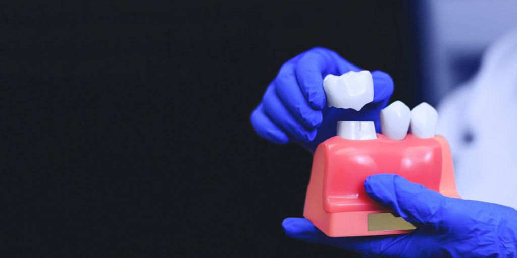 Getting a Traditional Crown