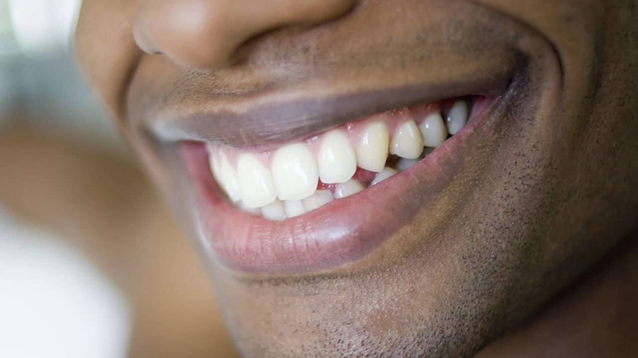 Tooth Discoloration: What To Do For It And How To Prevent It