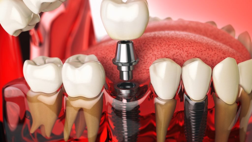 Cosmetic Dentistry and Dental Implants