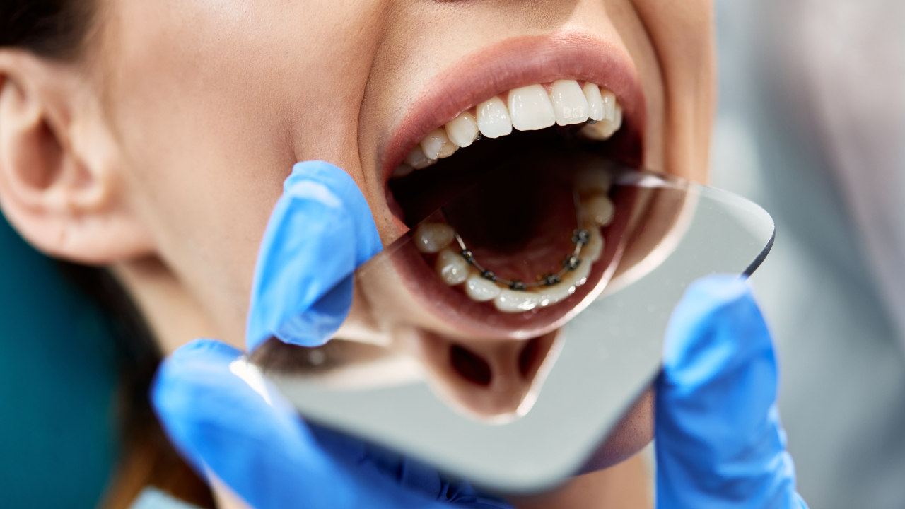 Orthodontic Appliance Fitting