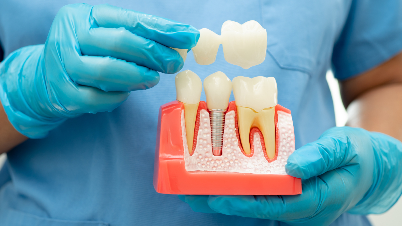 Porcelain Crown Service