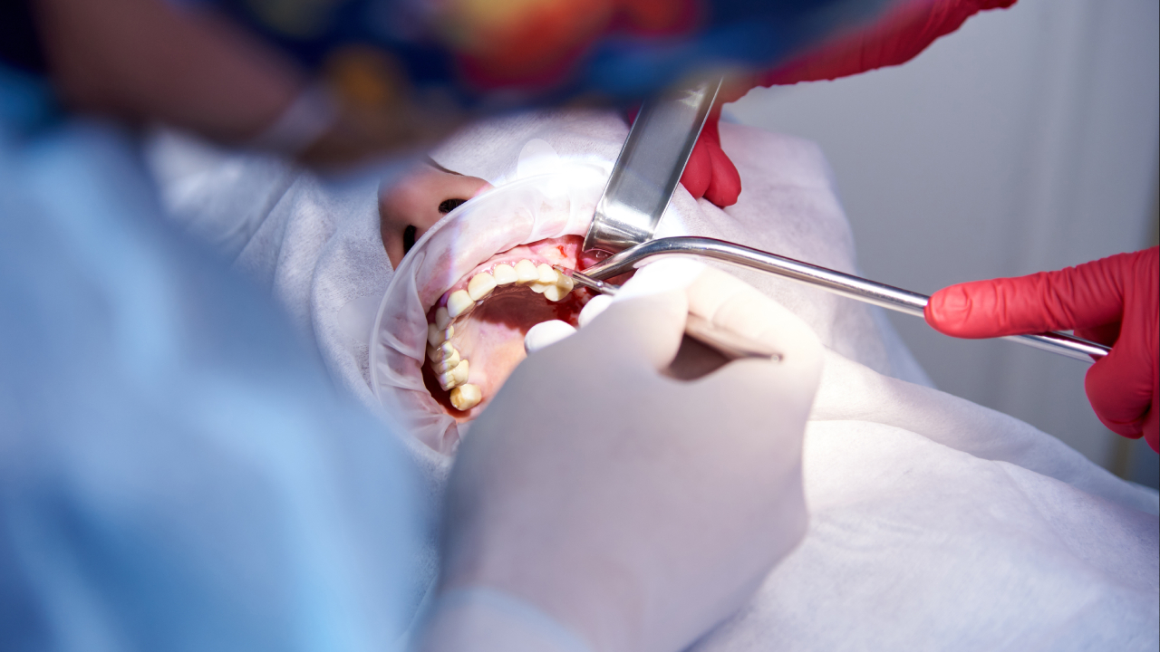 Surgical Tooth Extraction