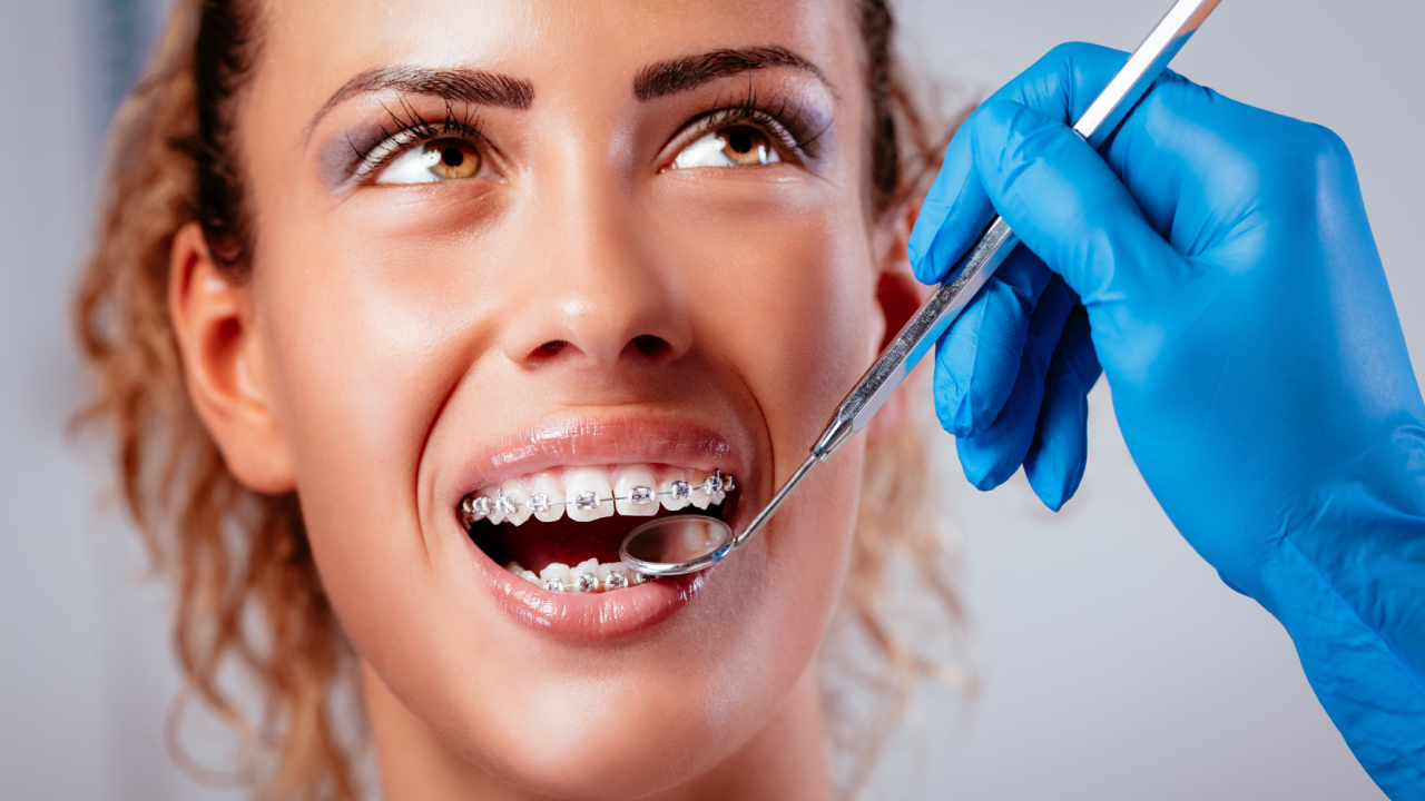 Surgically Facilitated Orthodontics SFOT