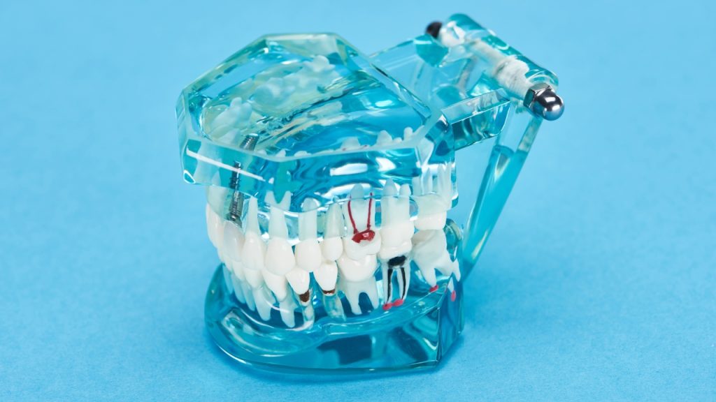 TMJ Oral Appliance