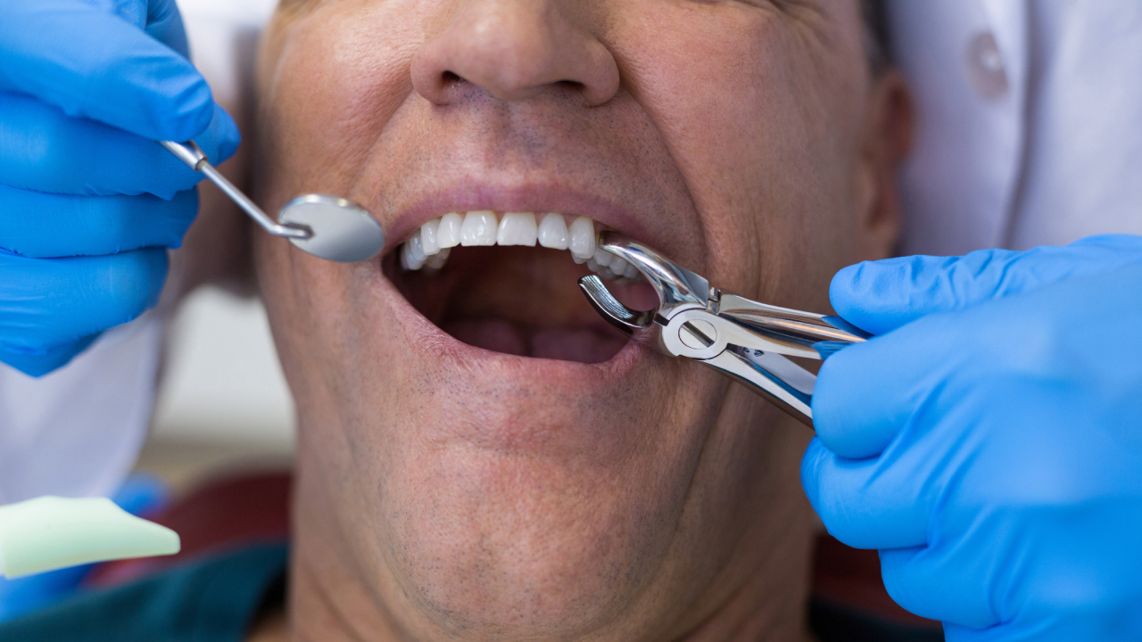 Wisdom Tooth Removal