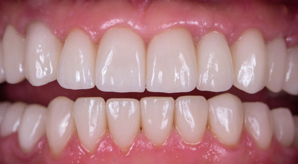dental-implants-after
