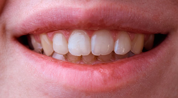 invisalign-after
