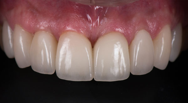 porcelain-veneers-after